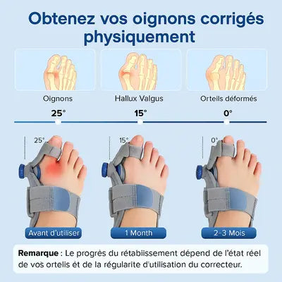 Correcteur de Hallux Confortable stade Léger à modéré CM